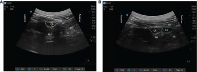 Ultrasound-guided posterior quadratus lumborum block can reduce postoperative opioid consumption and promote rapid recovery in patients undergoing sutureless laparoscopic partial nephrectomy: A triple-blind, randomized, controlled study